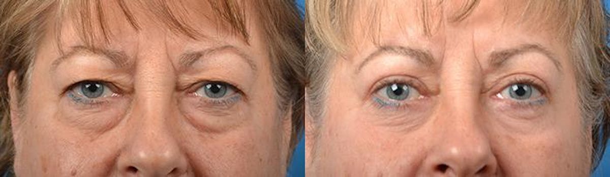 Eyelid Surgery Before & After Gallery - Patient 122406127 - Image 1