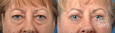 Eyelid Surgery Before & After Gallery - Patient 620398 - Image 1