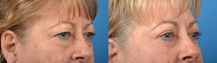 Eyelid Surgery Gallery - Patient 122406127 - Image 2