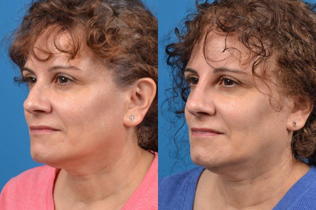 Liquid Rhinoplasty Before & After Gallery - Patient 122406128 - Image 4