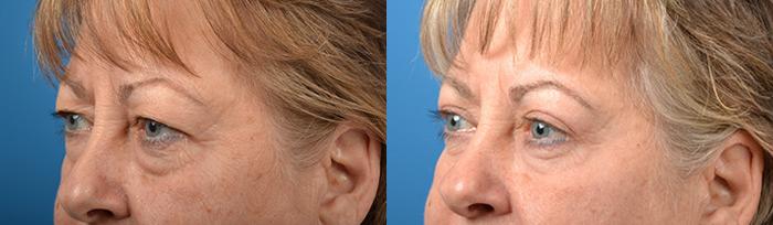 Eyelid Surgery Before & After Gallery - Patient 620398 - Image 3