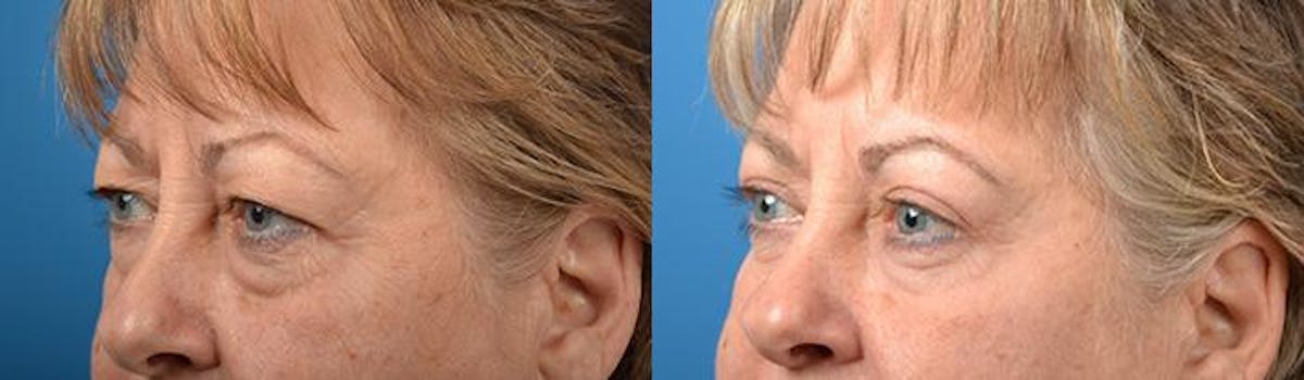 Eyelid Surgery Before & After Gallery - Patient 122406127 - Image 3