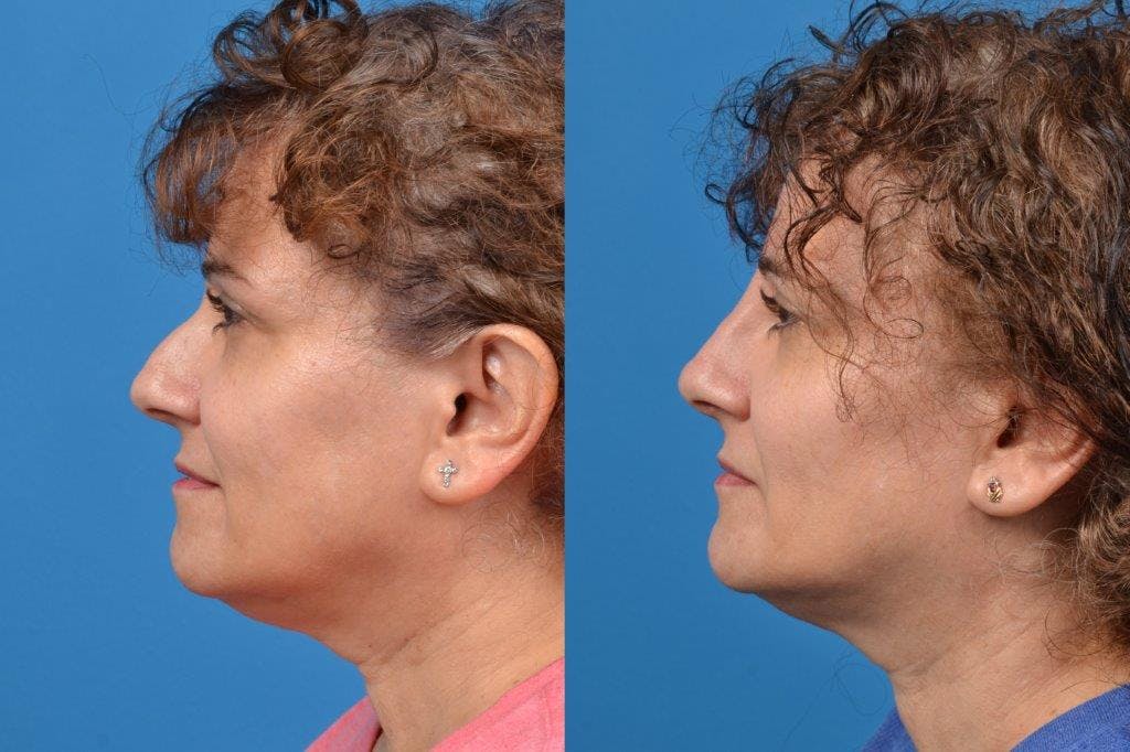 Liquid Rhinoplasty Before & After Gallery - Patient 122406128 - Image 5