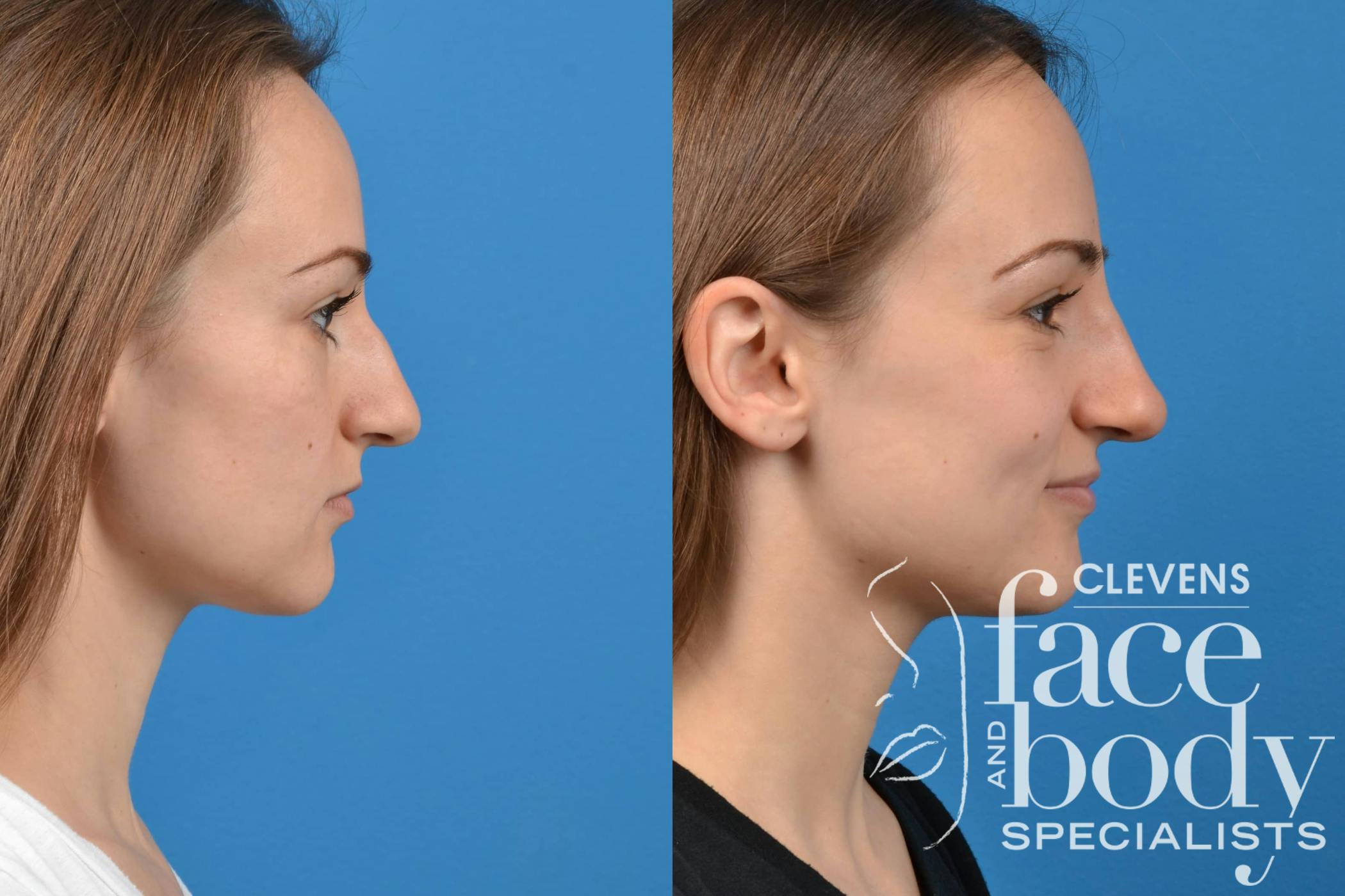 Rhinoplasty Procedure