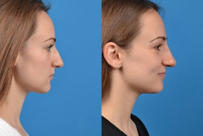 Liquid Rhinoplasty Before & After Gallery - Patient 122406133 - Image 1