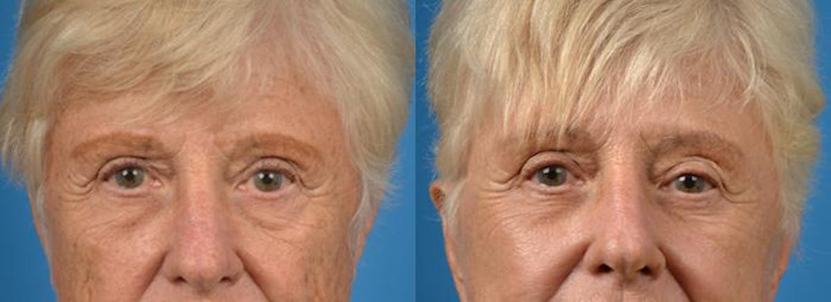 Eyelid Surgery Before & After Gallery - Patient 122406130 - Image 1
