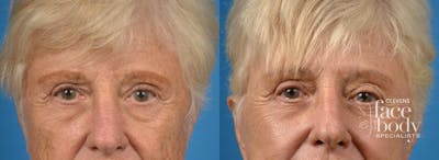 Eyelid Surgery Before & After Gallery - Patient 198641 - Image 1