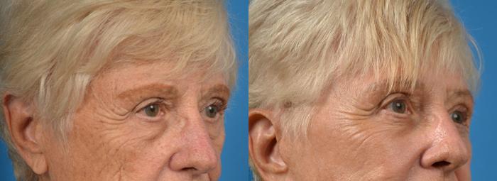 Eyelid Surgery Before & After Gallery - Patient 198641 - Image 2