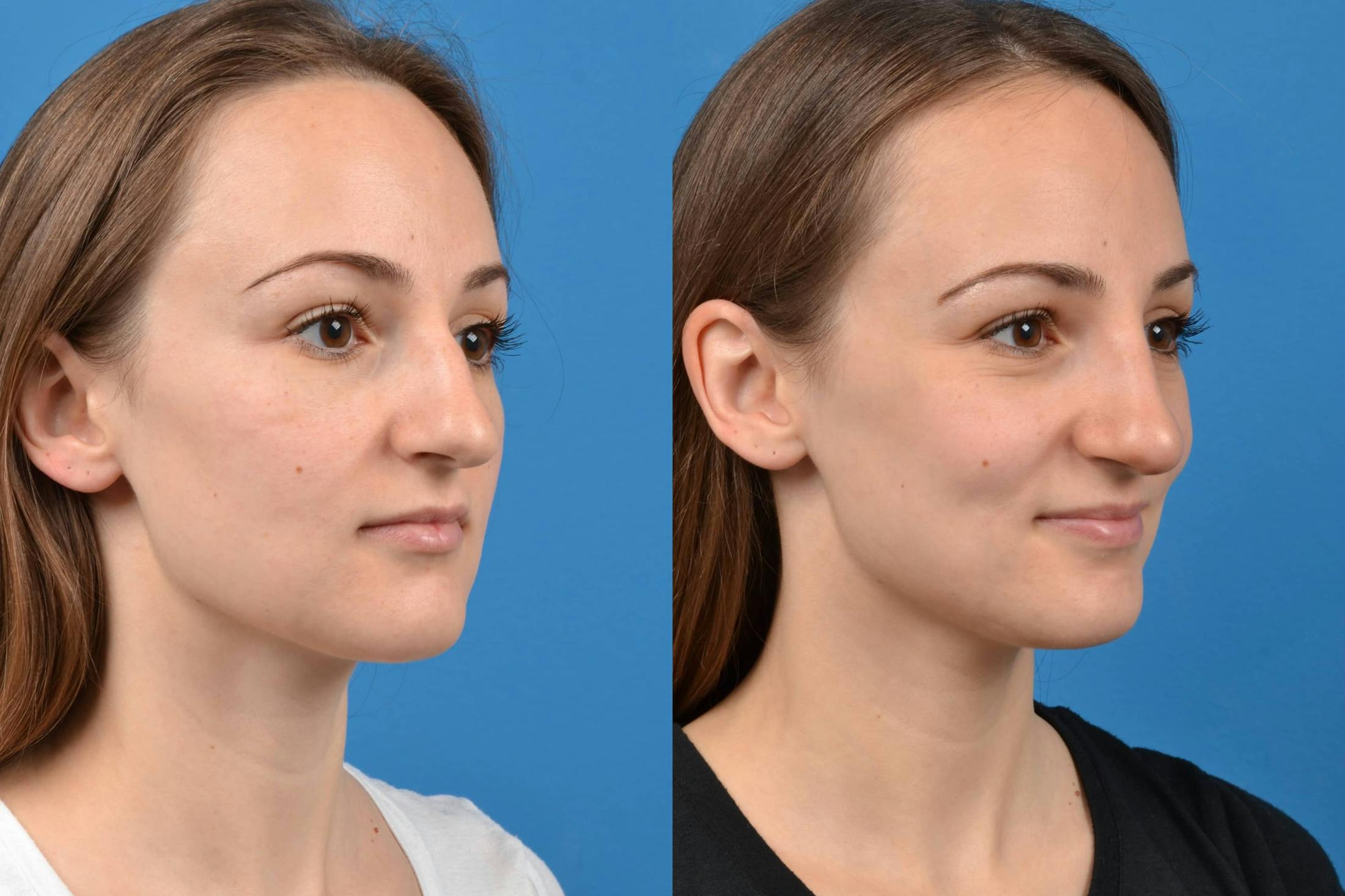 Liquid Rhinoplasty Before & After Gallery - Patient 122406133 - Image 2
