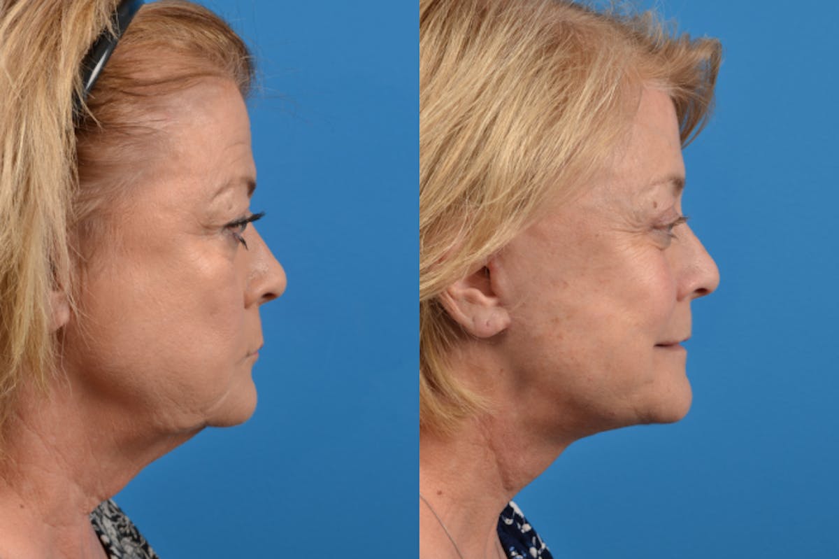 Facelift Before & After Gallery - Patient 122406131 - Image 5