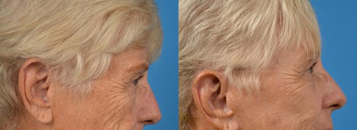 Eyelid Surgery Before & After Gallery - Patient 198641 - Image 3