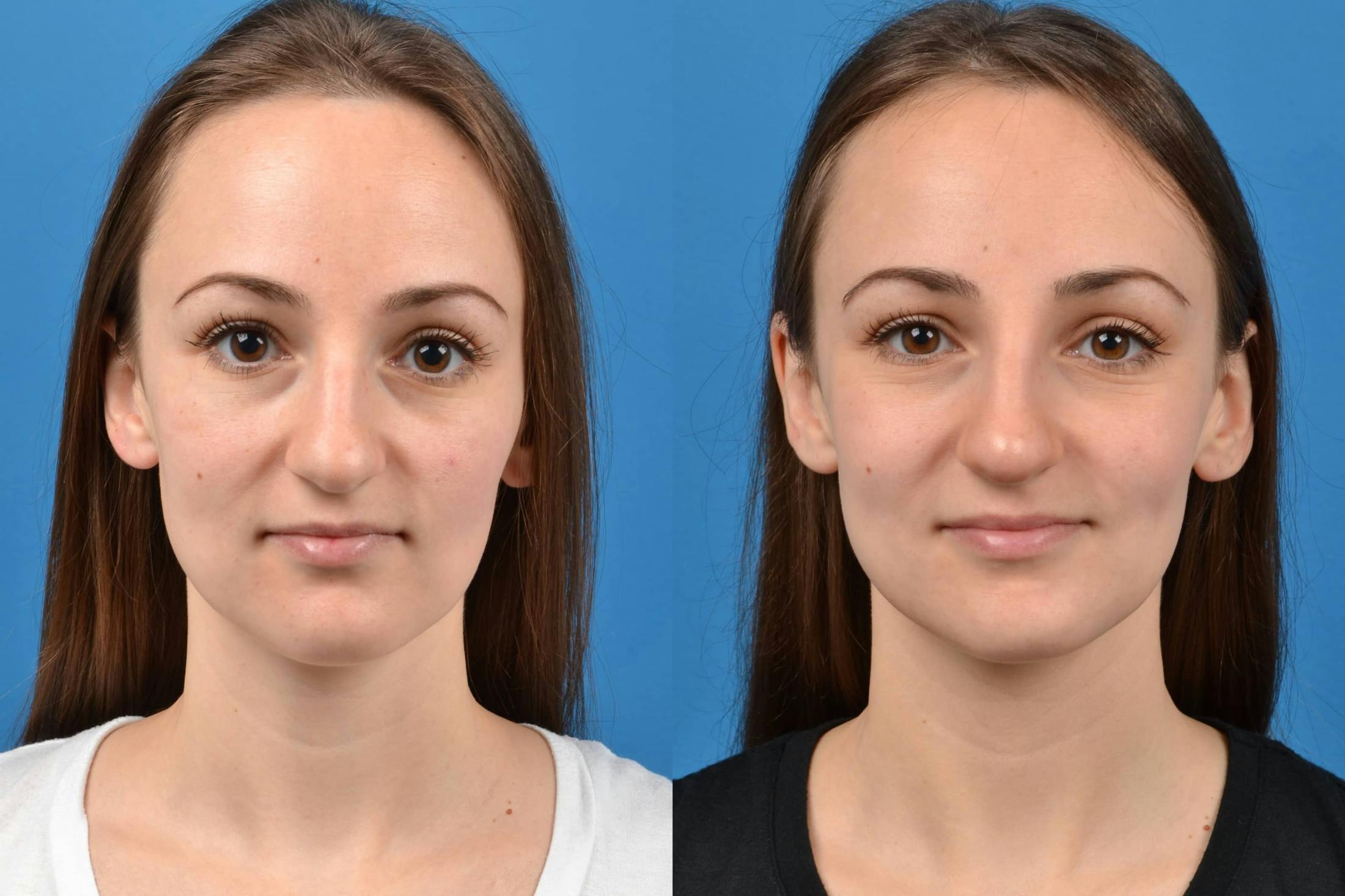 Liquid Rhinoplasty Before & After Gallery - Patient 122406133 - Image 3