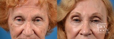 Eyelid Surgery Before & After Gallery - Patient 212466 - Image 1