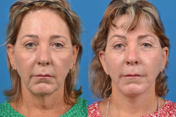 Facelift Before & After Gallery - Patient 122406135 - Image 1