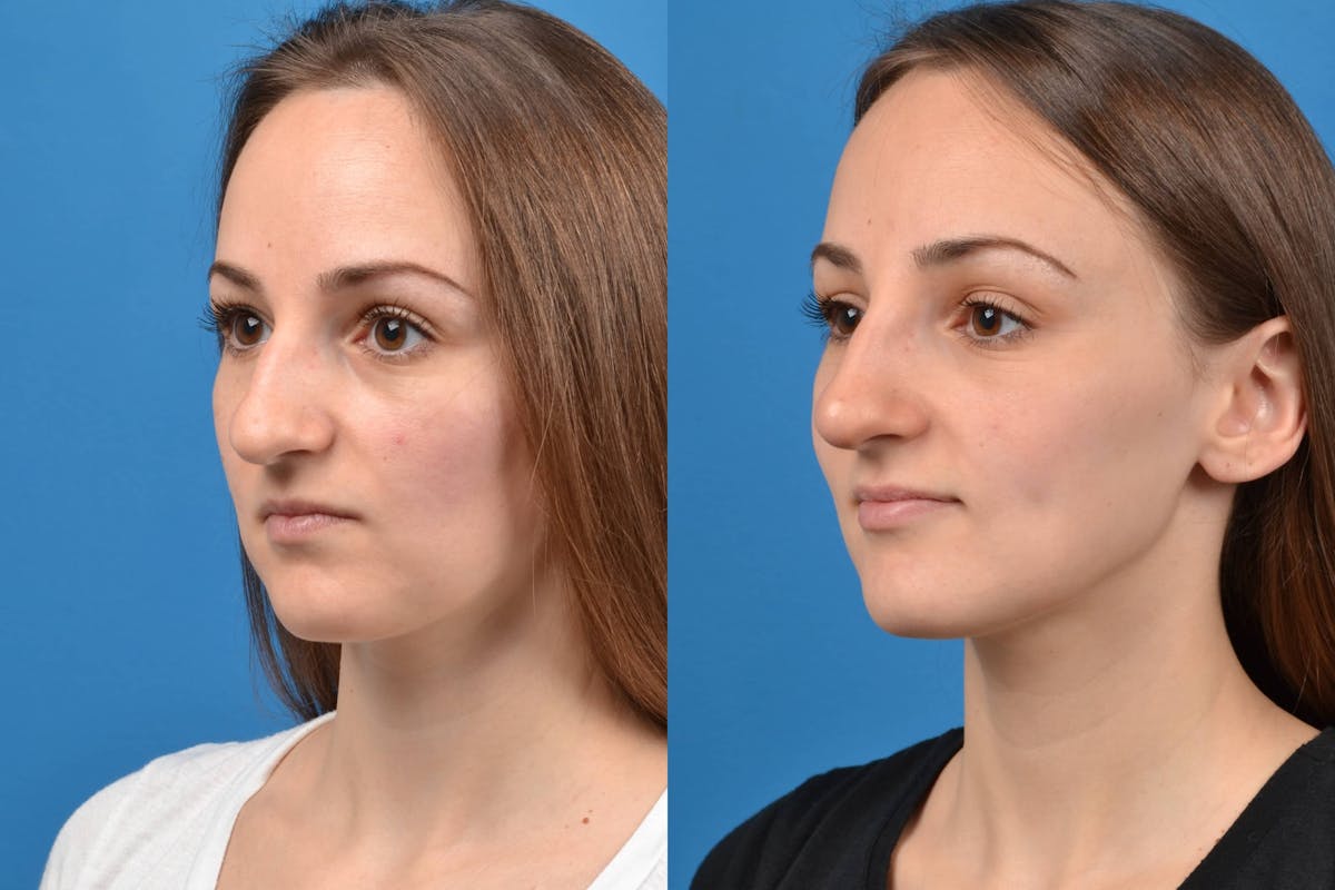 Liquid Rhinoplasty Before & After Gallery - Patient 122406133 - Image 4