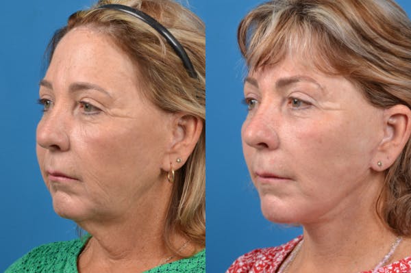 Facelift Before & After Gallery - Patient 122406135 - Image 2