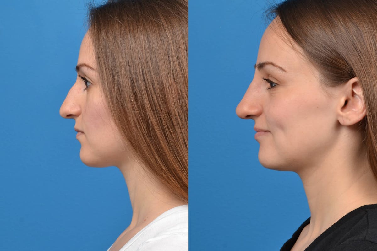 Liquid Rhinoplasty Before & After Gallery - Patient 122406133 - Image 5