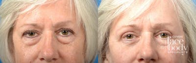 Eyelid Surgery Before & After Gallery - Patient 291734 - Image 1