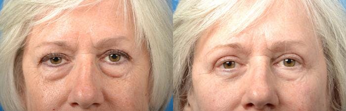 Eyelid Surgery Before & After Gallery - Patient 122406134 - Image 1
