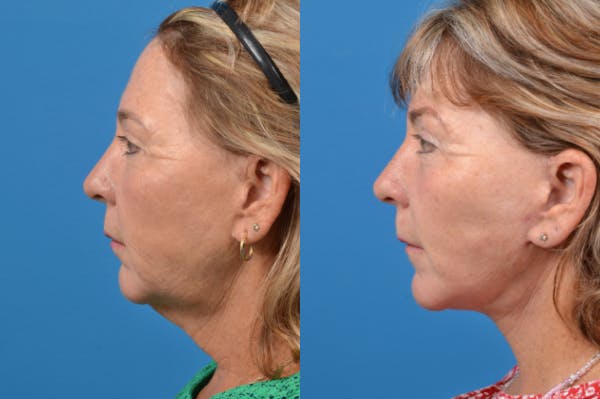 Facelift Before & After Gallery - Patient 122406135 - Image 3