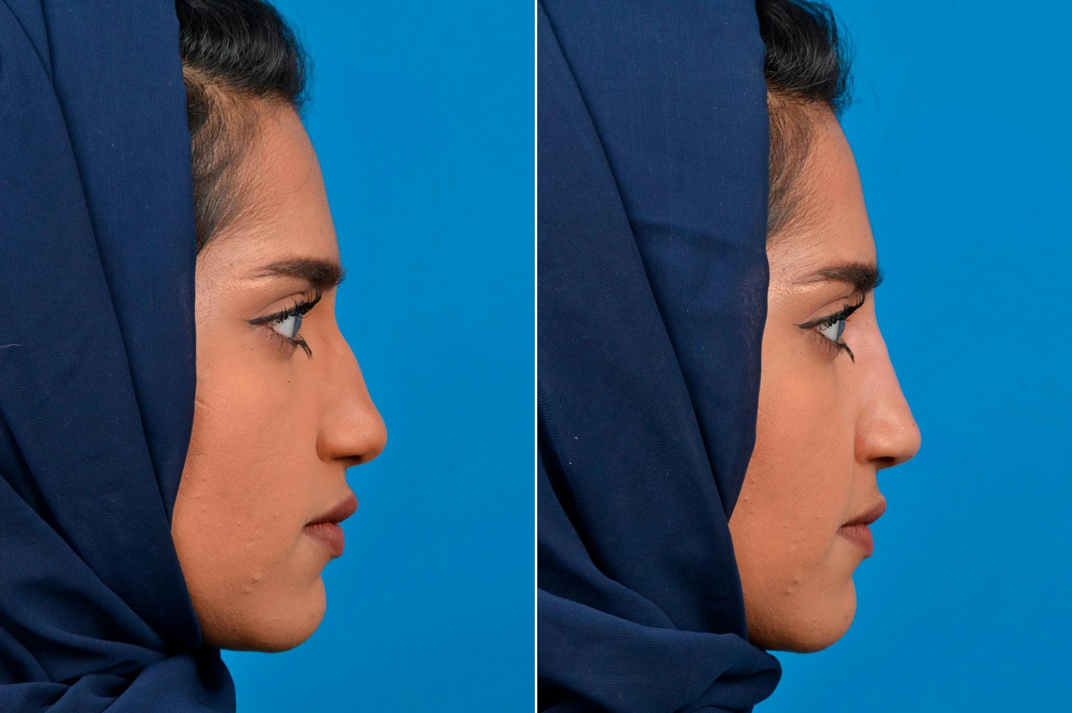 Rhinoplasty Procedure