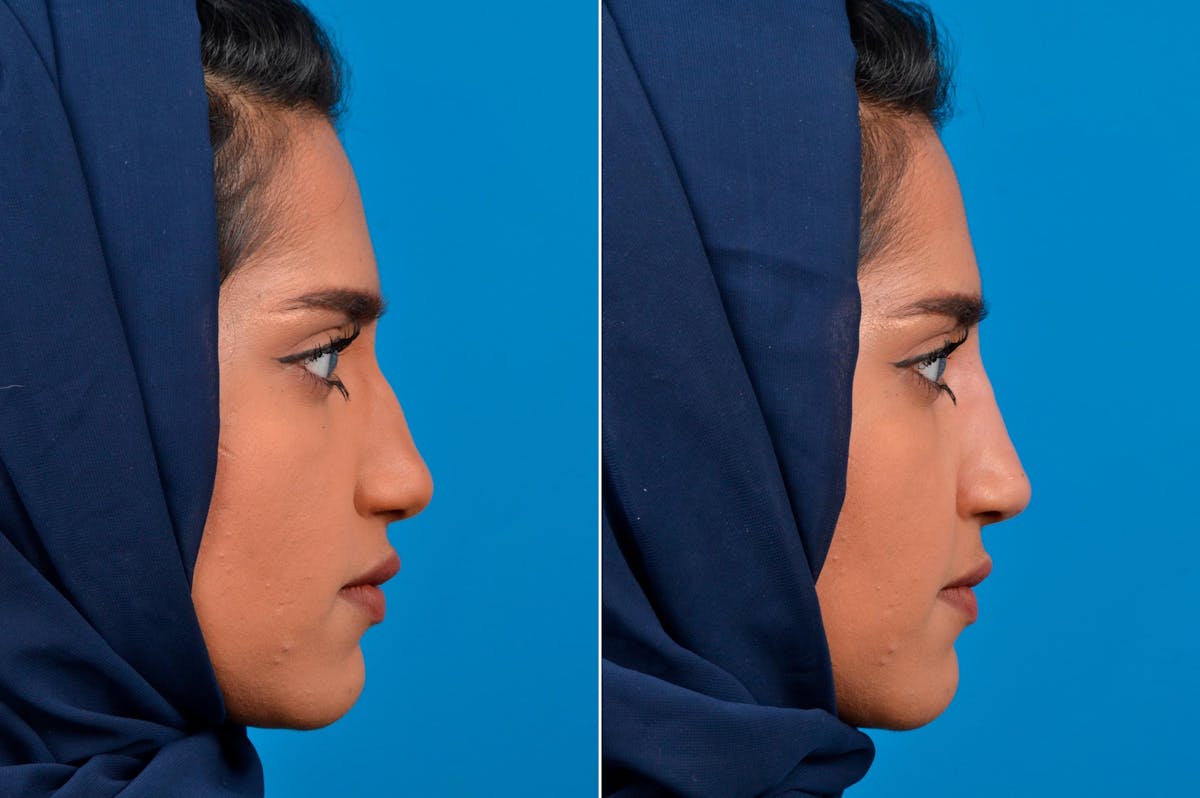 Liquid Rhinoplasty Before & After Gallery - Patient 122406138 - Image 1