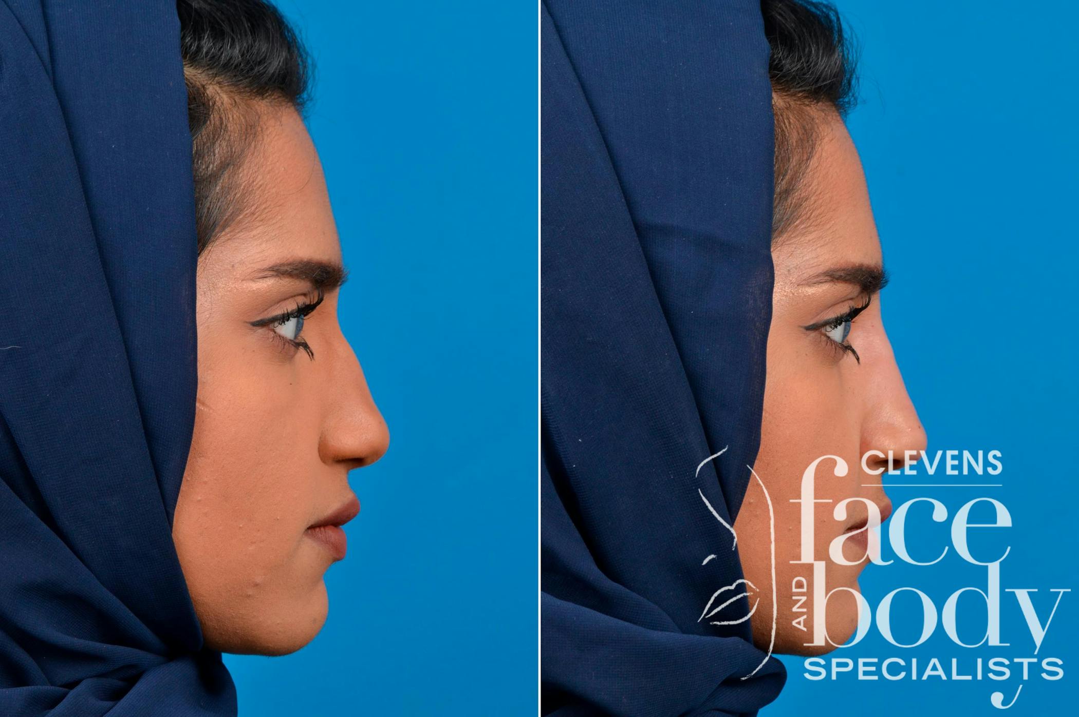 Rhinoplasty Procedure