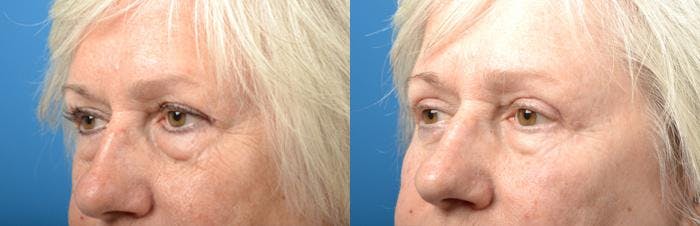 Eyelid Surgery Before & After Gallery - Patient 122406134 - Image 2