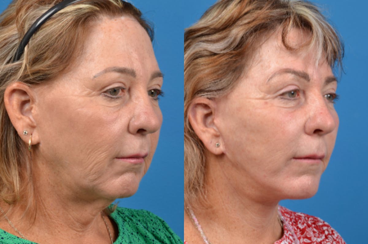 Facelift Before & After Gallery - Patient 122406135 - Image 4