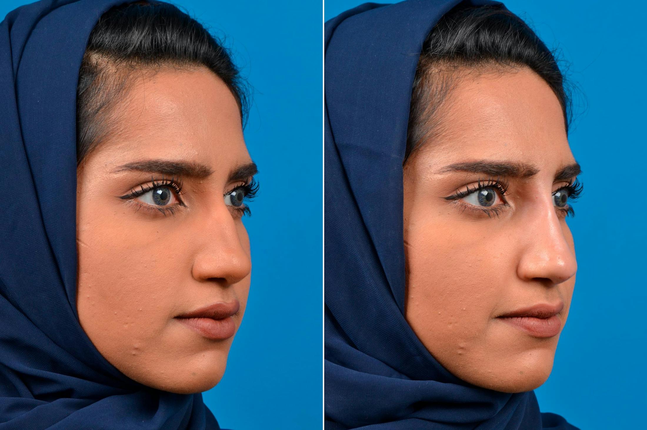 Liquid Rhinoplasty Before & After Gallery - Patient 122406138 - Image 2