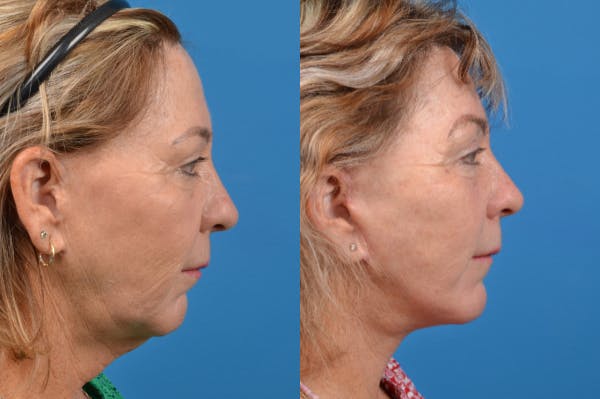 Facelift Before & After Gallery - Patient 122406135 - Image 5