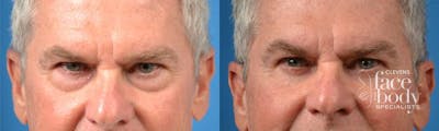 Eyelid Surgery Before & After Gallery - Patient 149961 - Image 1