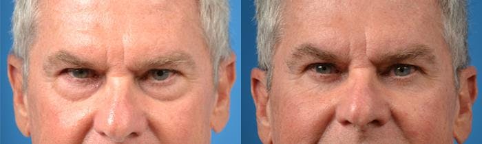 Eyelid Surgery Before & After Gallery - Patient 122406136 - Image 1