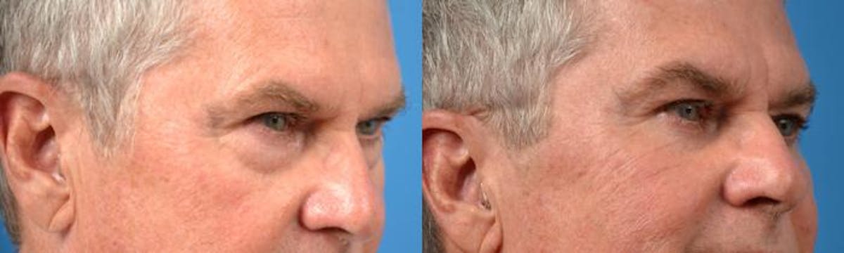 Eyelid Surgery Before & After Gallery - Patient 122406136 - Image 2