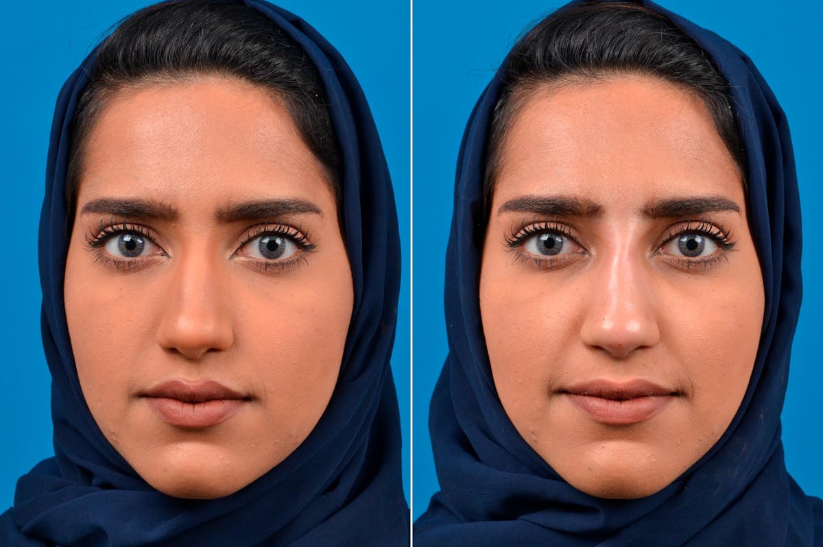 Liquid Rhinoplasty Before & After Gallery - Patient 122406138 - Image 3