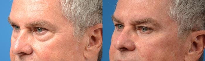 Eyelid Surgery Before & After Gallery - Patient 122406136 - Image 3