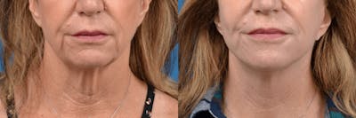 Facelift Before & After Gallery - Patient 122406139 - Image 1