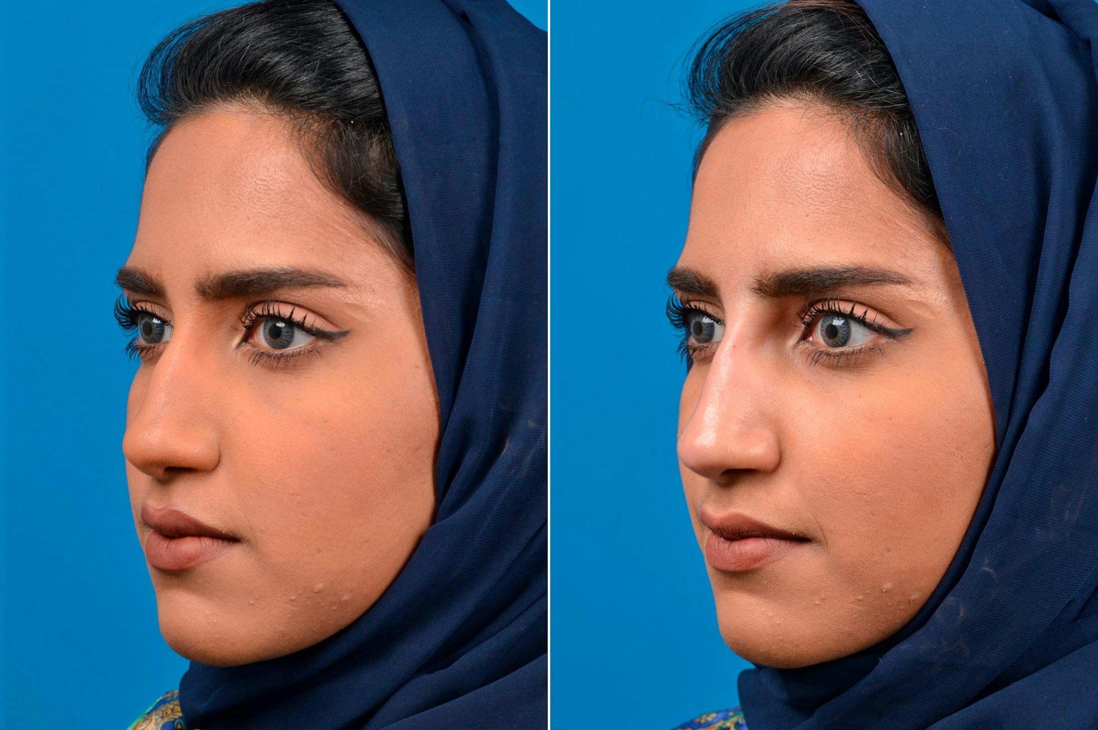 Liquid Rhinoplasty Before & After Gallery - Patient 122406138 - Image 4