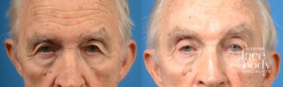 Eyelid Surgery Before & After Gallery - Patient 117890 - Image 1