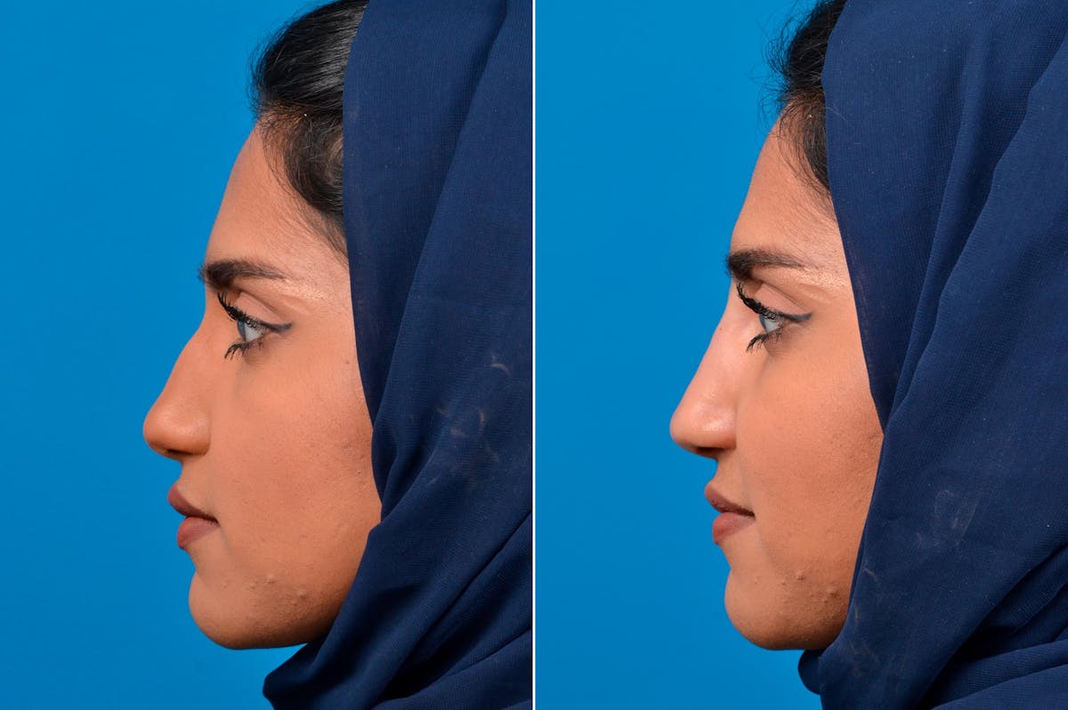 Liquid Rhinoplasty Before & After Gallery - Patient 122406138 - Image 5