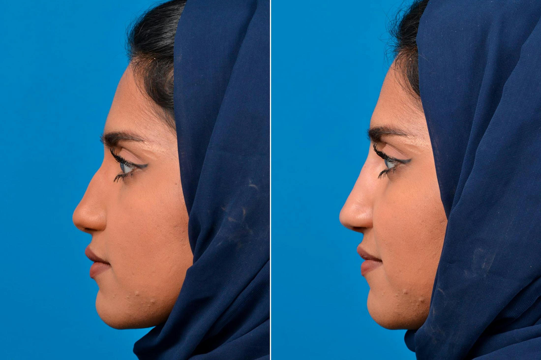Liquid Rhinoplasty Before & After Gallery - Patient 122406138 - Image 5