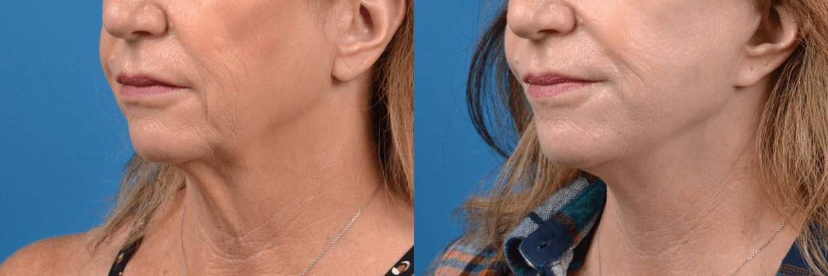 Facelift Before & After Gallery - Patient 122406139 - Image 2
