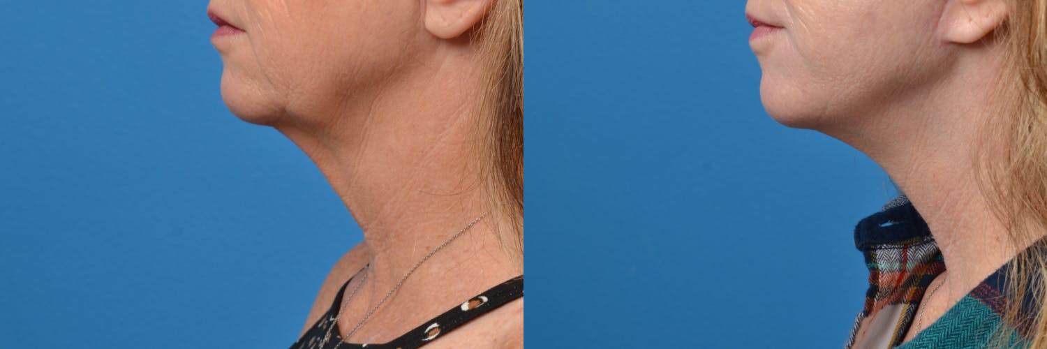 Facelift Before & After Gallery - Patient 122406139 - Image 3