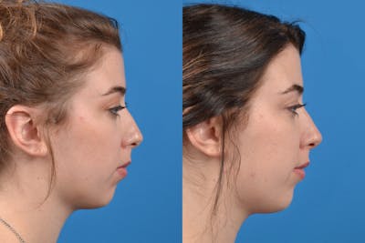 Liquid Rhinoplasty Before & After Gallery - Patient 122406144 - Image 1