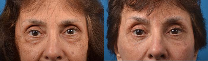 Eyelid Surgery Before & After Gallery - Patient 258383 - Image 1