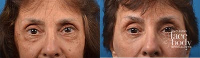 Eyelid Surgery Before & After Gallery - Patient 258383 - Image 1