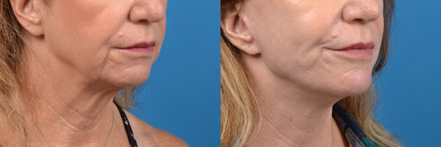 Facelift Before & After Gallery - Patient 122406139 - Image 4