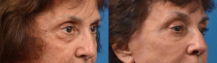Eyelid Surgery Before & After Gallery - Patient 258383 - Image 2