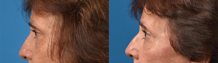 Eyelid Surgery Before & After Gallery - Patient 258383 - Image 3