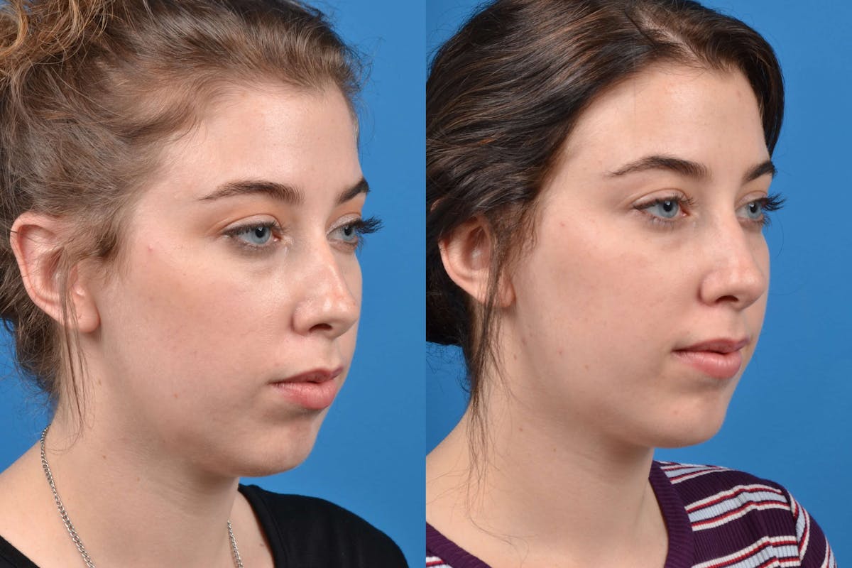 Liquid Rhinoplasty Before & After Gallery - Patient 122406144 - Image 2